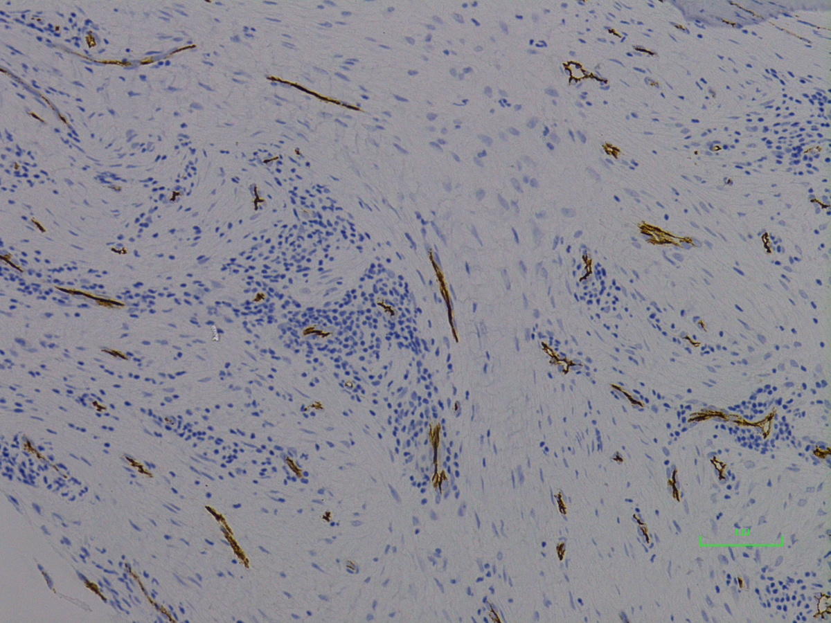 Bone marrow, CD34 IHC